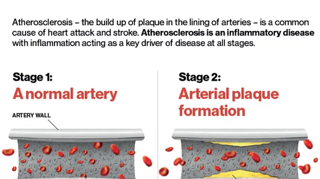 Atherosclerosis – the build up of plaque in the lining of arteries – is a common cause of heart attack and stroke