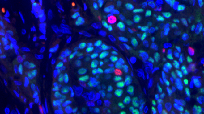 Painted cellular image of breast cancer
