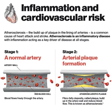 Atherosclerosis – the build up of plaque in the lining of arteries – is a common cause of heart attack and stroke
