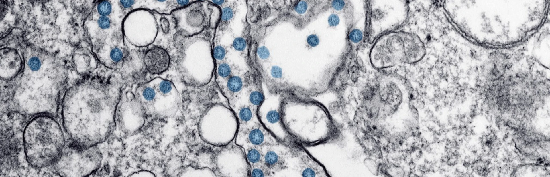 Transmission electron microscopic image of an isolate from a case of coronavirus disease (COVID-19)