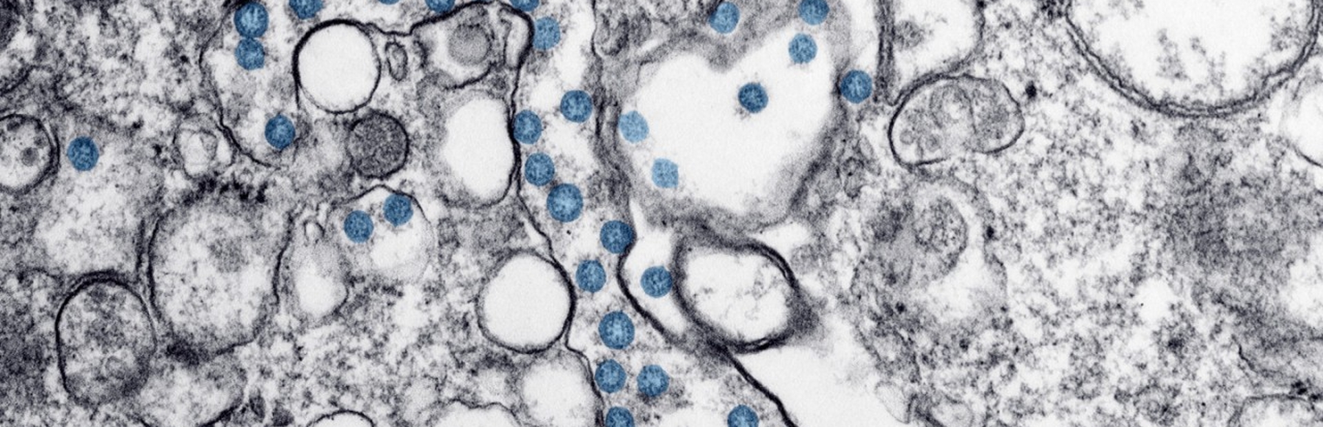 Transmission electron microscopic image of an isolate from a case of coronavirus disease (COVID-19)