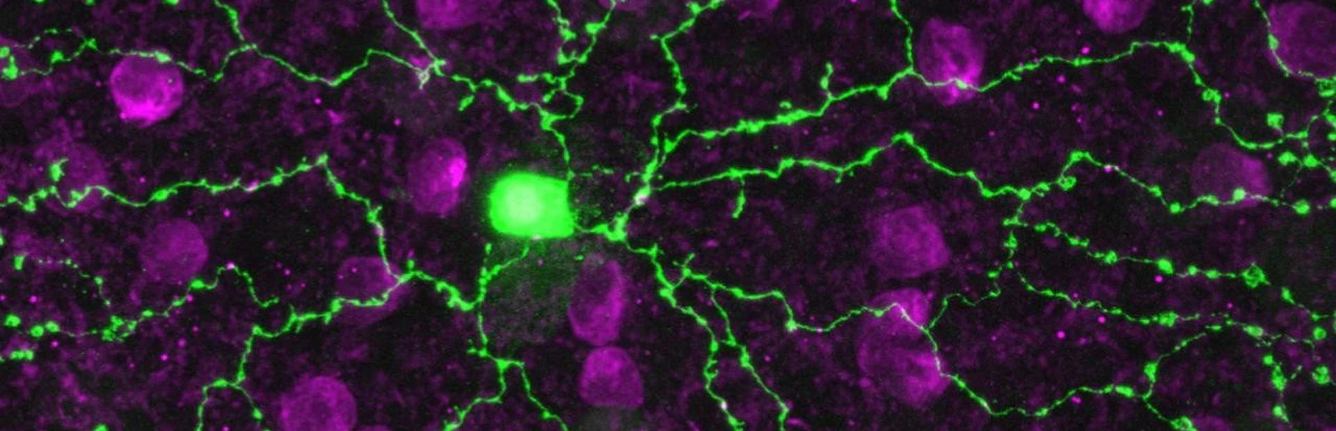 Eye disease tracked to a glitch in starburst cells