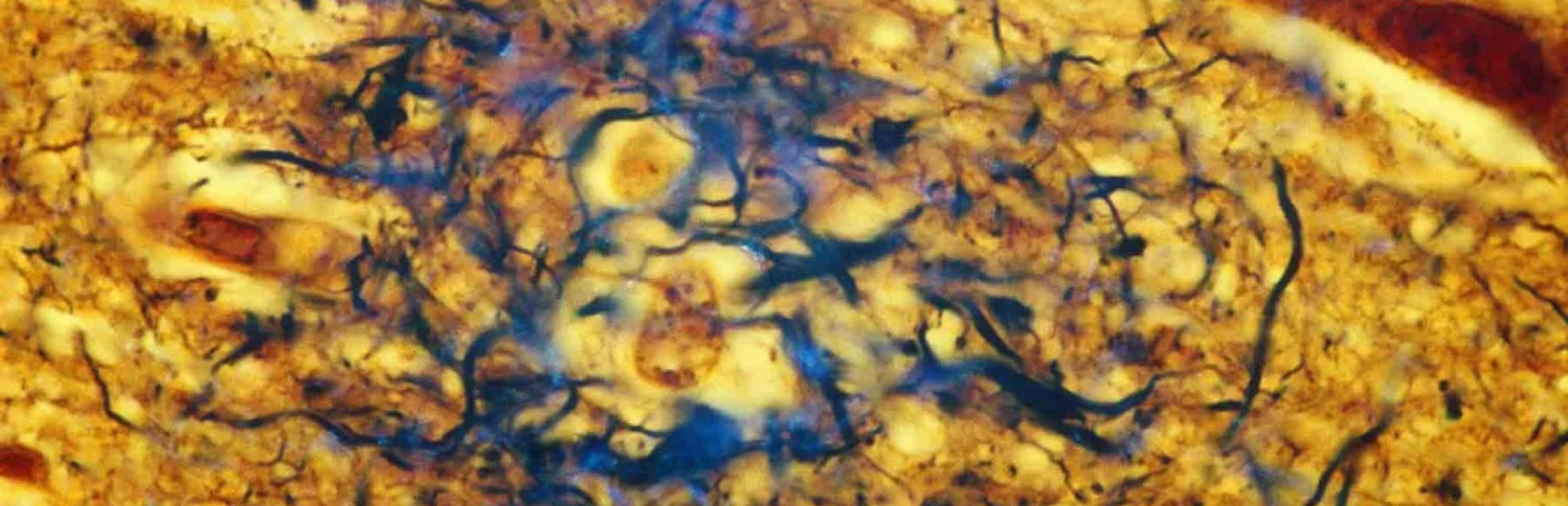 Stopping Alzheimer's disease before it starts