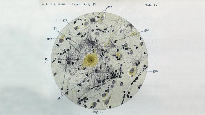 The earliest evidence of amyloid plaques.