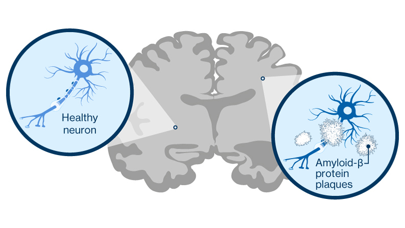 Amyloid plaques in the brain