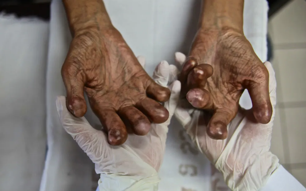 Leprosy can cause deformity in patients as a result of nerve damage