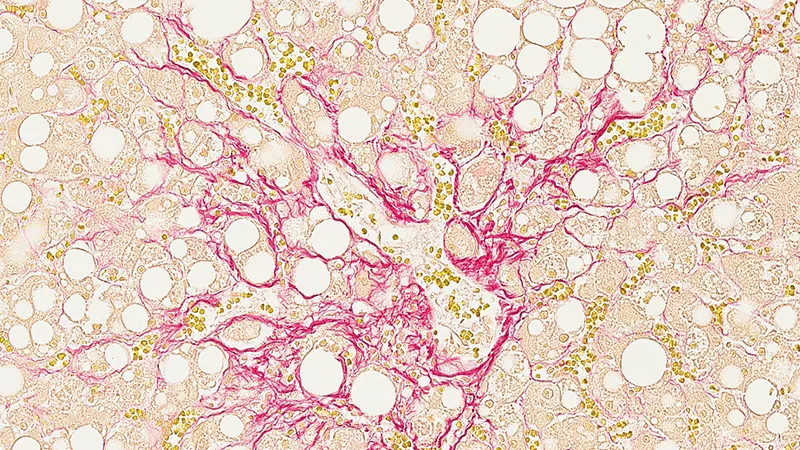 Liver tissue with fat buildup and scarring