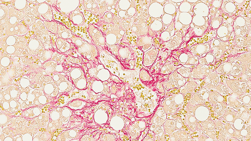 Liver tissue with fat buildup and scarring
