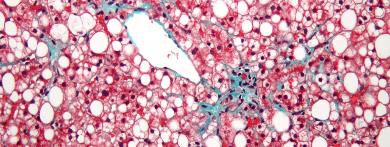  Leveraging the liver’s ability to heal scarred tissue