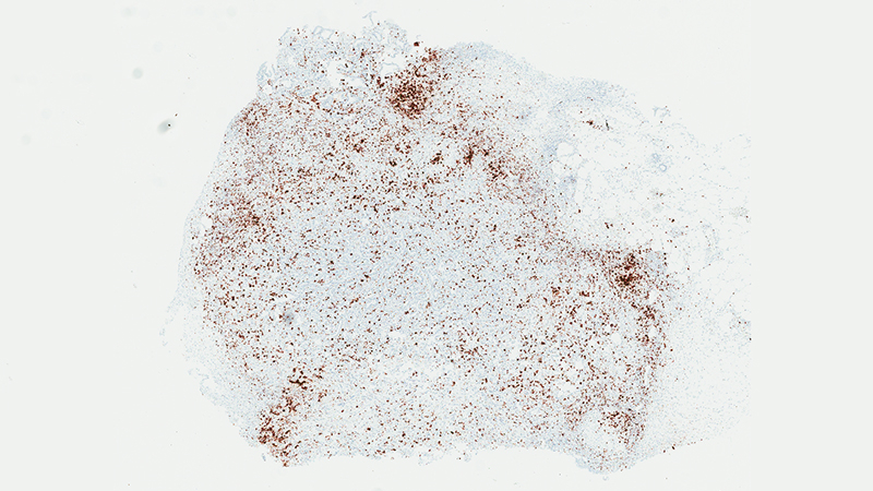 IL-1 beta molecules (stained brown) cluster around tumors and act like a smoke screen for cancer. 