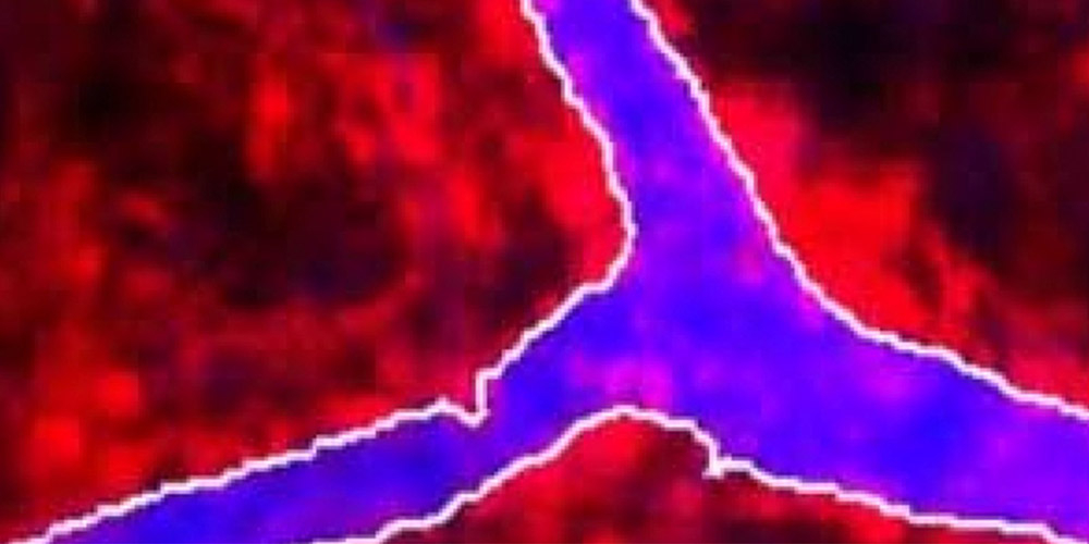 Rendering of atherosclerosis