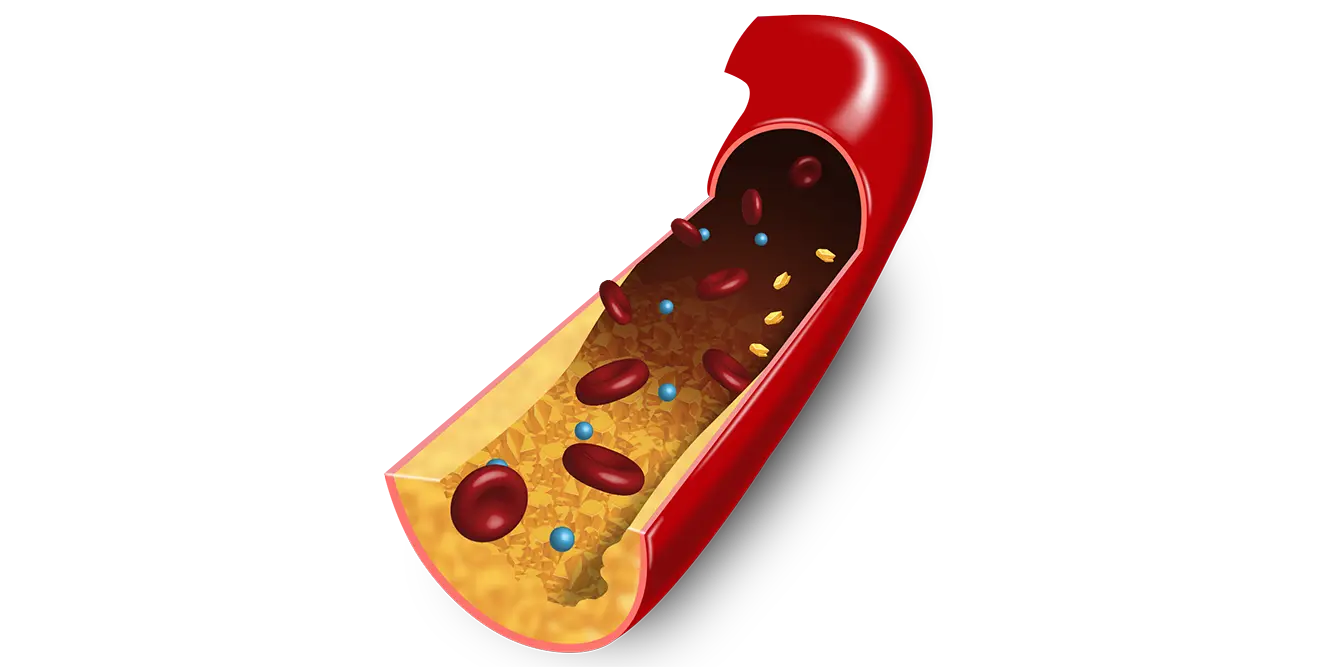 3D Illustration of ASCVD