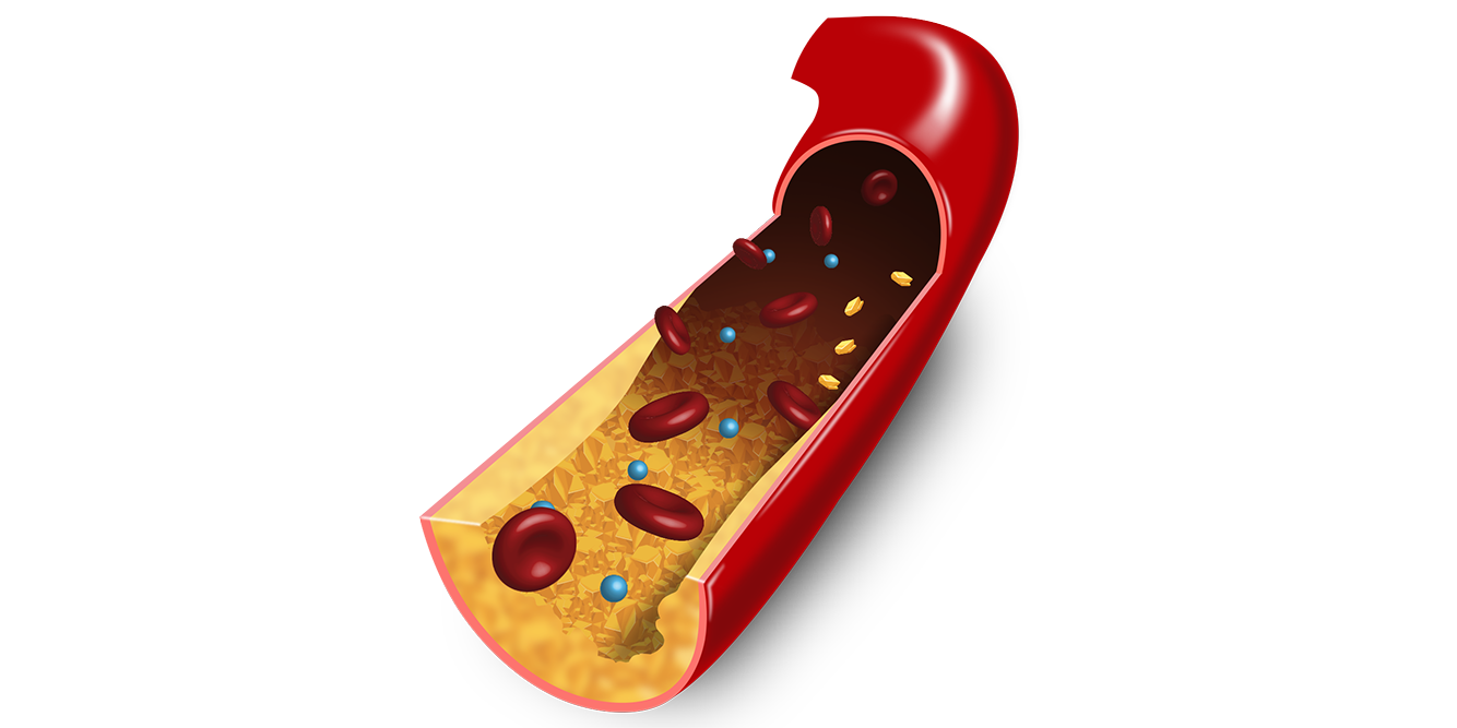 3D Illustration of ASCVD