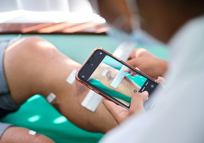 A healthcare worker measures a patient’s healed CL lesion