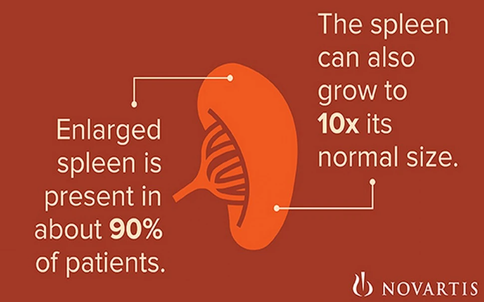 Enlarged spleen infographic