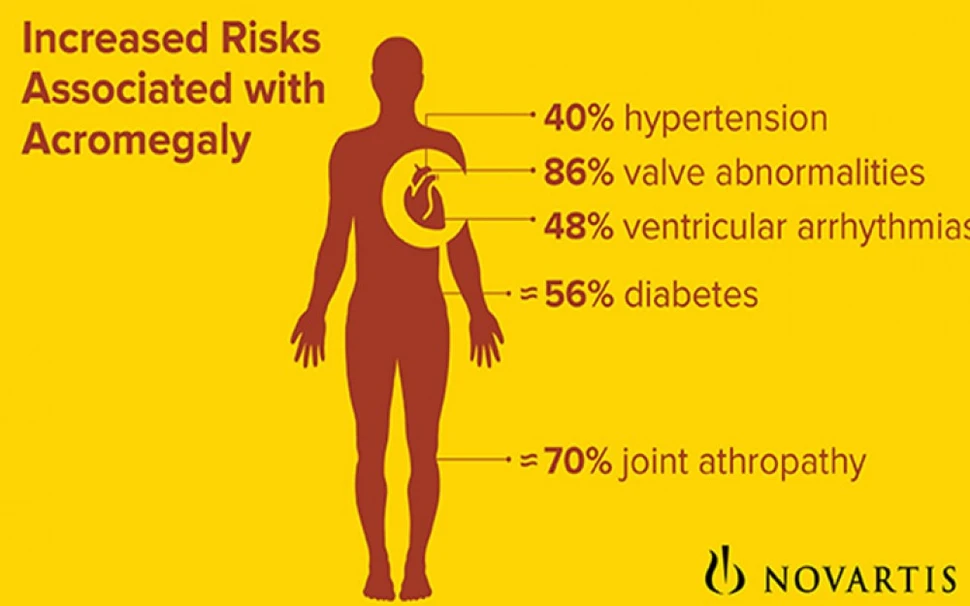 Acromegaly infographic