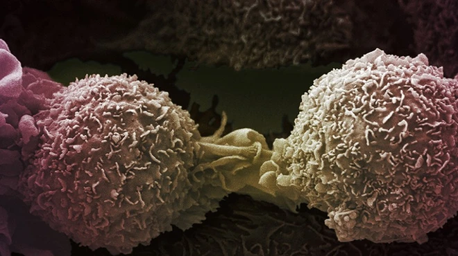 Lung cancer cells by Ann Weston, LRI, CRUK, Welcome Images