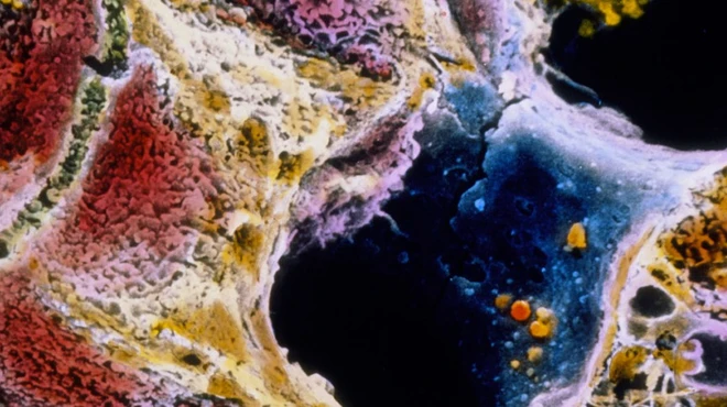 Scar tissue (light brown) has invaded this lobule of a liver affected by cirrhosis. SEM image by Motta & Fujita/Science Photo Library