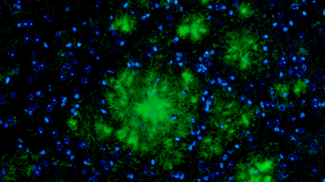 Amyloid plaques (green) in brain tissue.
