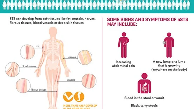 Advanced Soft Tissue Sarcoma Infographic