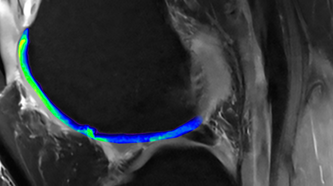 MRI technology reveals cartilage in knees