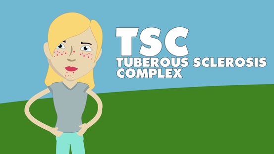 Managing the TSC Transition to Adult Care