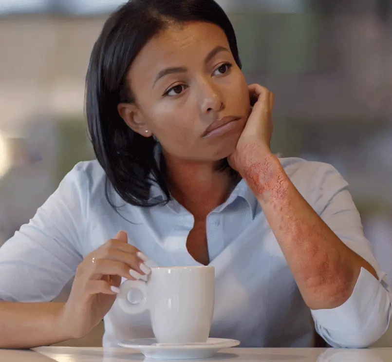 Woman with hives on her arm