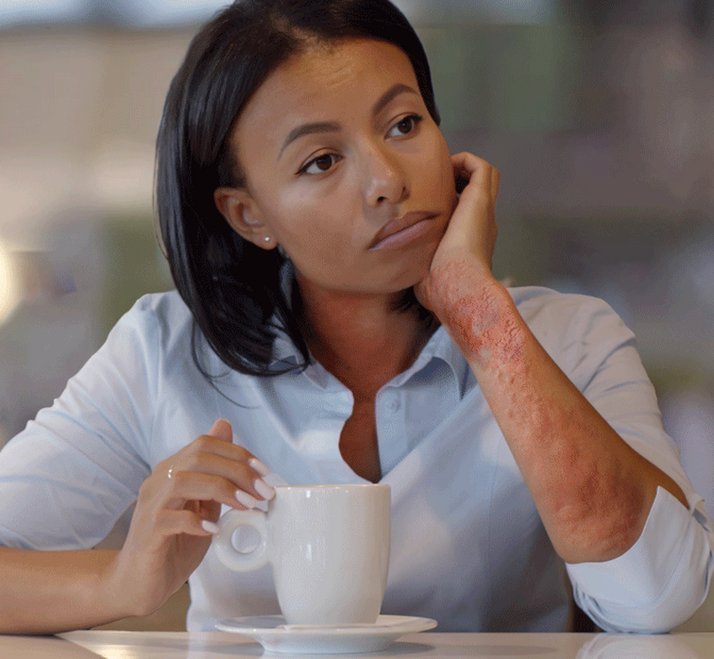 Patient Portrayal - A woman with hives on her forearm 