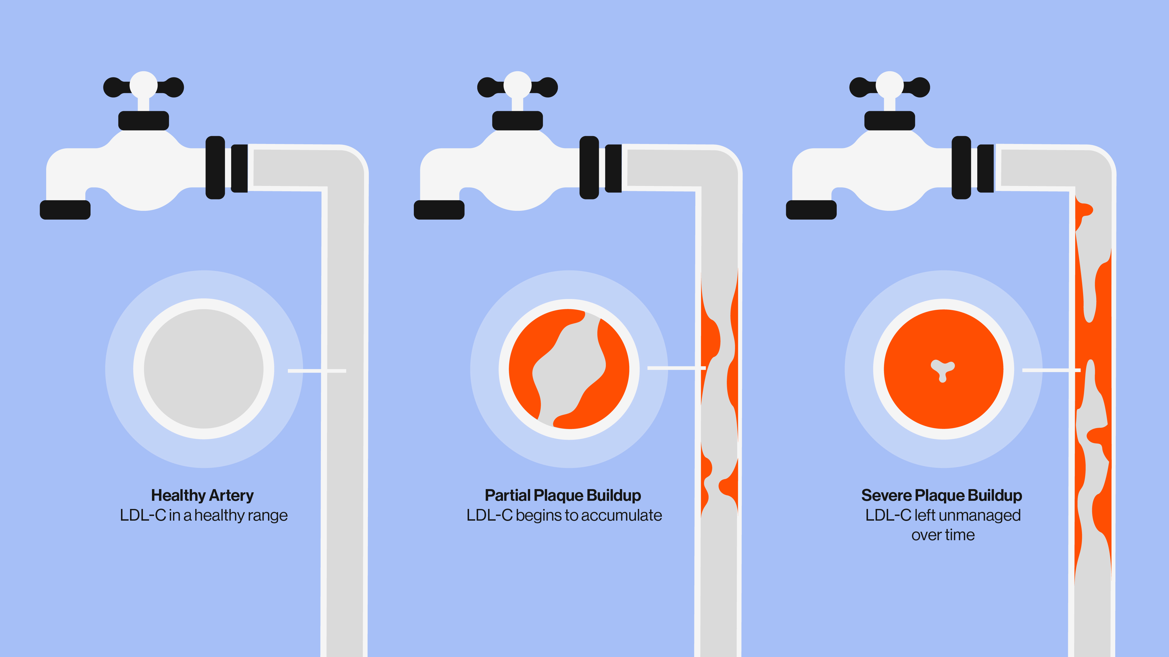 An illustration that shows the difference between healthy arteries and some with various stages of plaque buildup. 