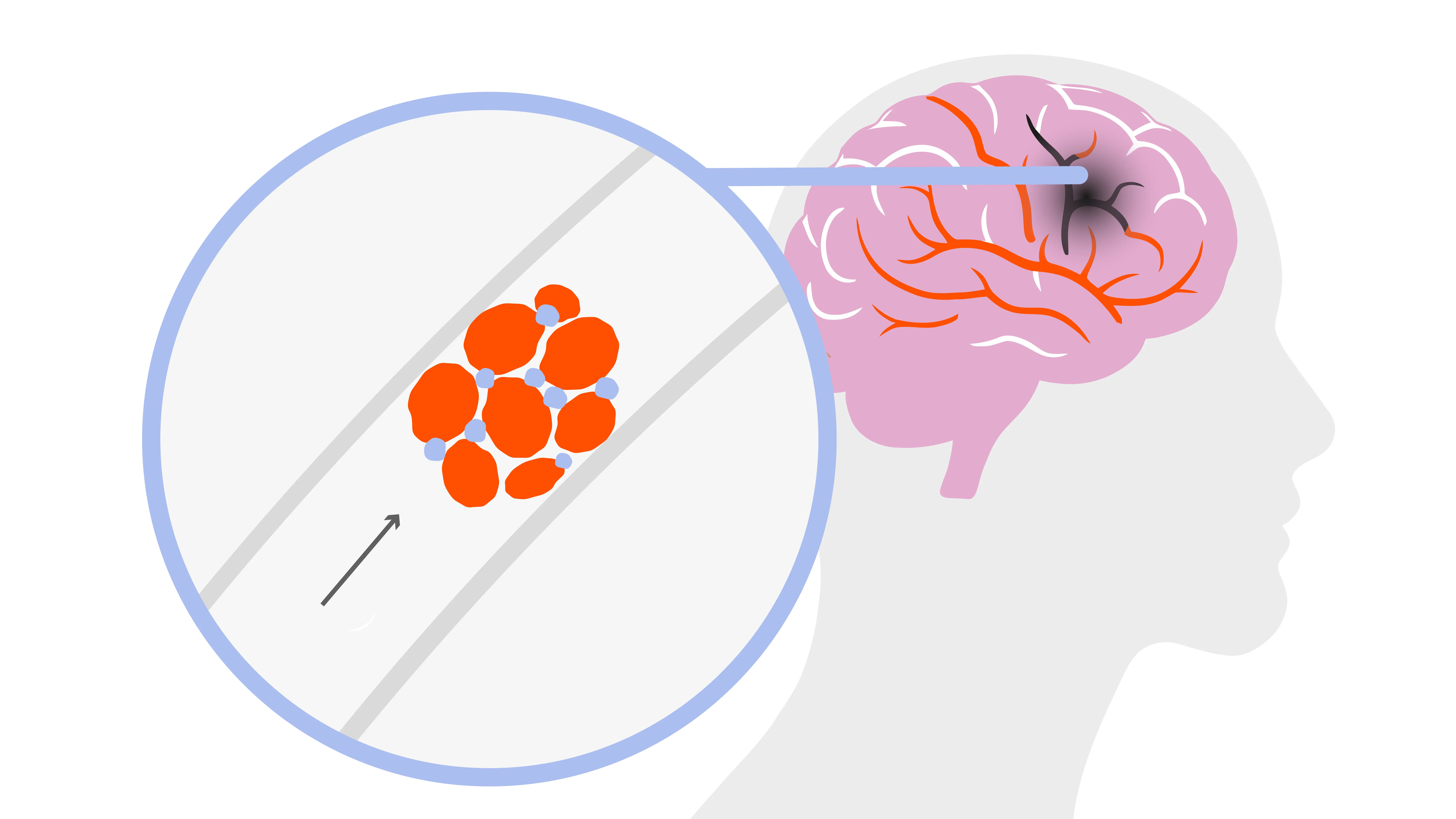 AFib rhythm clotting