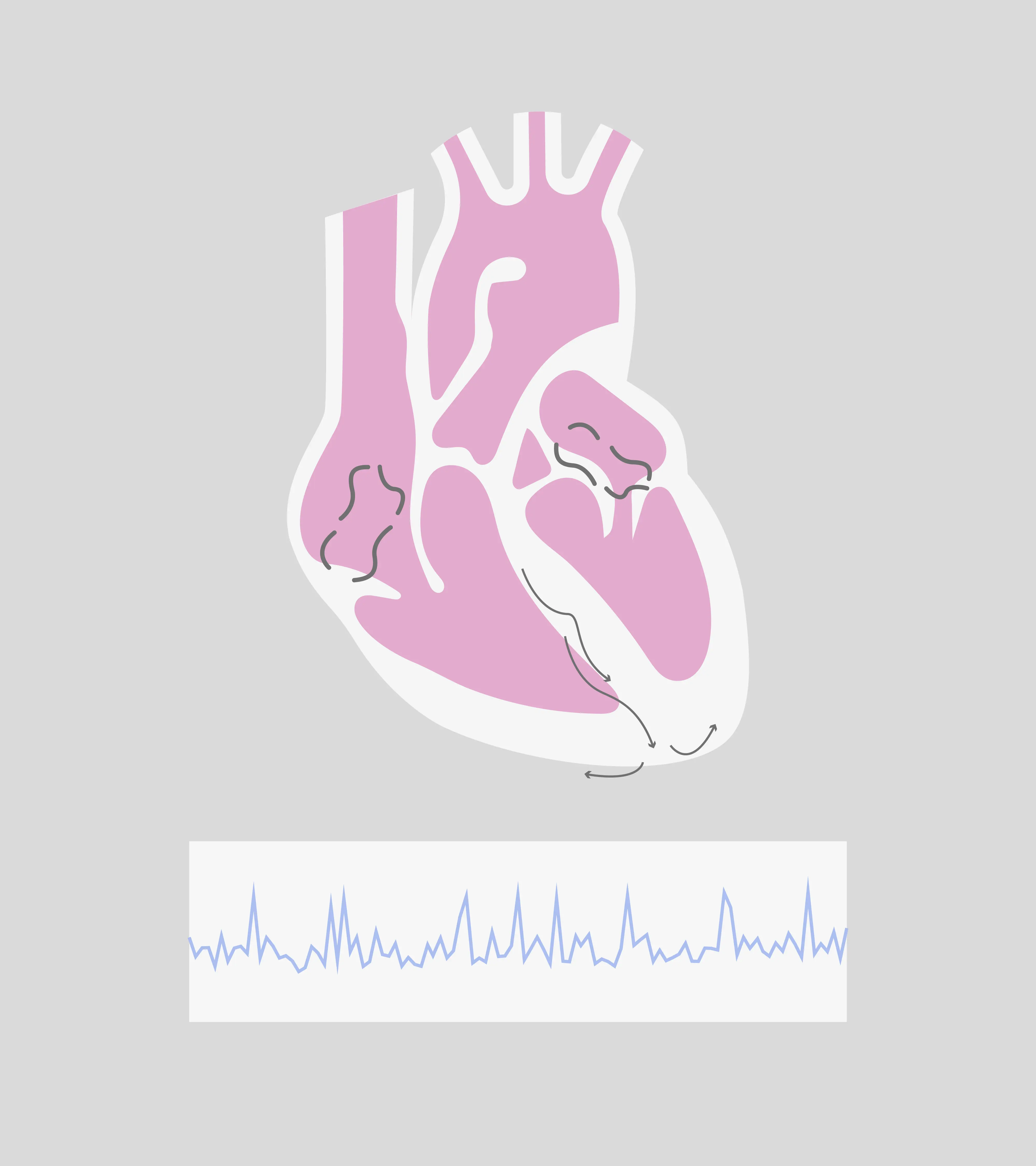 AFib rhythm.